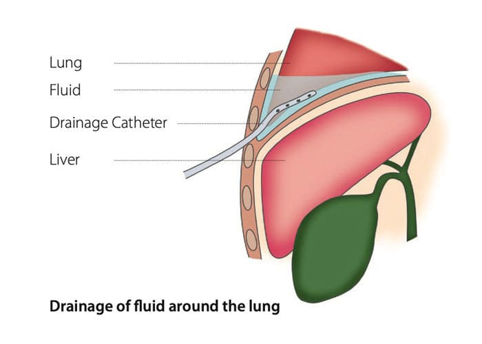 Drainage of fluid around the lung